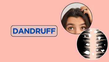 Dandruff & Urticaria