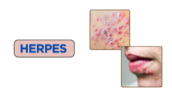 Herpes Infections Treatment