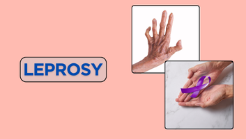 Leprosy Treatment