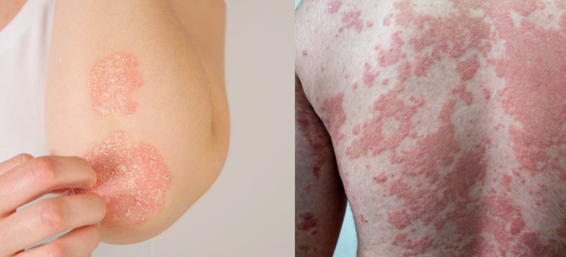 Psoriasis Treatment