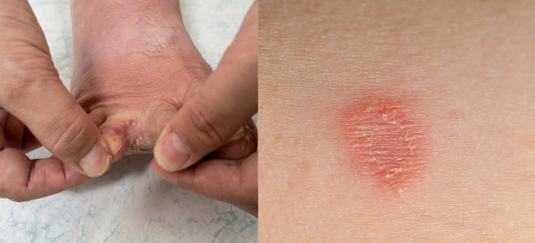Tinea Infections Treatment