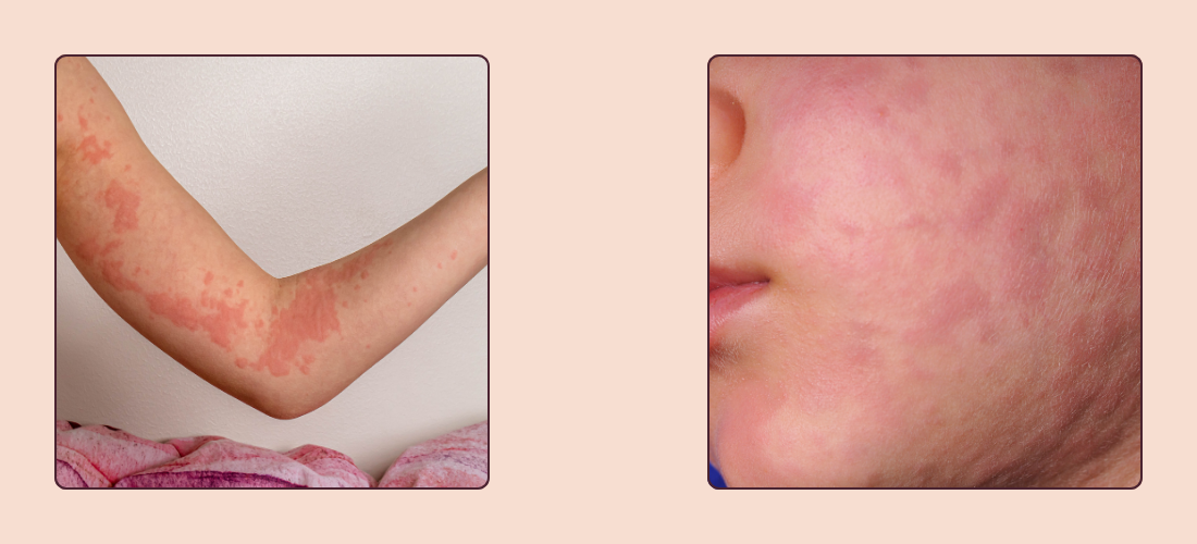 Urticaria (Hives) Treatment