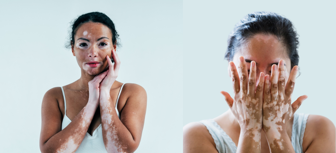 Vitiligo Treatment