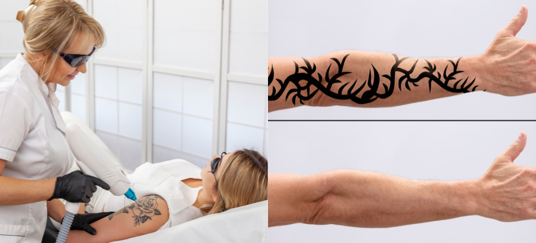 Laser Tattoo Removal Treatment