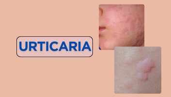 Dandruff & Urticaria